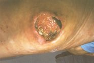 LESION (37)  IMAGENES FOTOS
